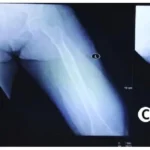 Interventional Radiology in Treating Vascular Malformations