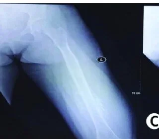 Interventional Radiology in Treating Vascular Malformations
