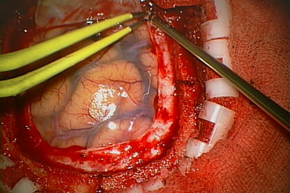 Brain Surgery for Traumatic Injuries