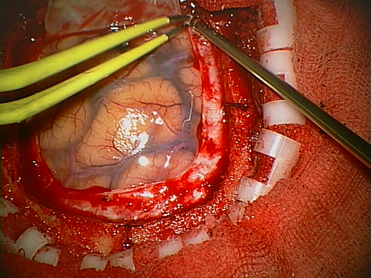 Brain Surgery for Traumatic Injuries