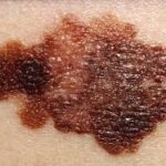 When To Be Concerned About Moles